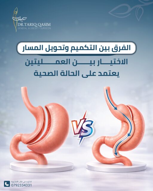 الفرق بين التكميم وتحويل المسارللاستشارة الطبية الدقيقة:📞 0792334331#الدكتور_طارق_قاسم #الجراحة_العامّة_والمنظار #السمنة #التكميم #تحويل_المسار